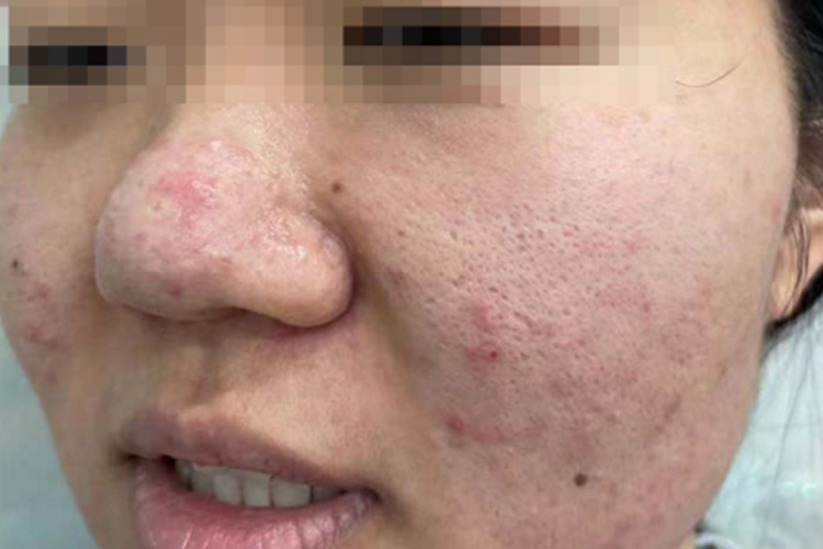 痤疮炎性丘疹图