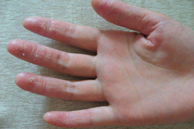 进行性掌跖角化病症状图 进行性掌跖角化病症状图