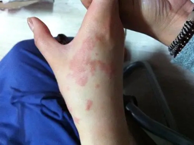 油漆皮炎右手手背起红色斑片图