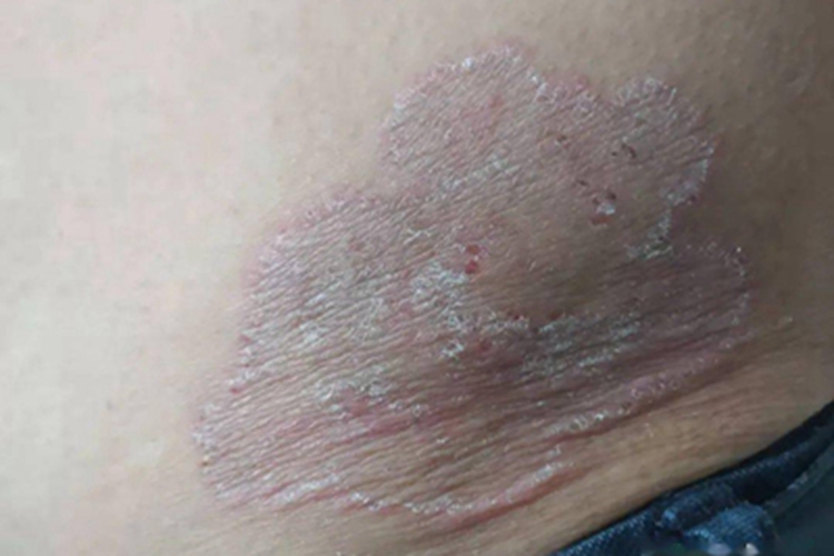 体癣腰部脱屑图