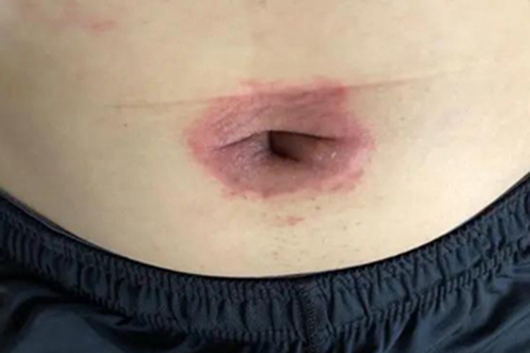 炎症后色素沉着红斑图