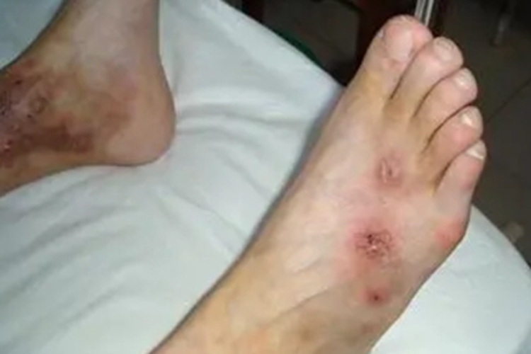 变应性皮肤结节性血管炎疙瘩图