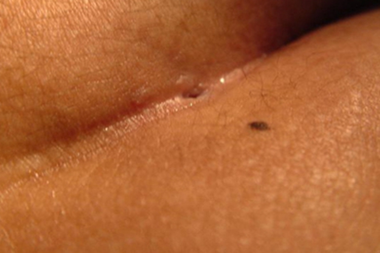 藏毛窦臀部小孔图