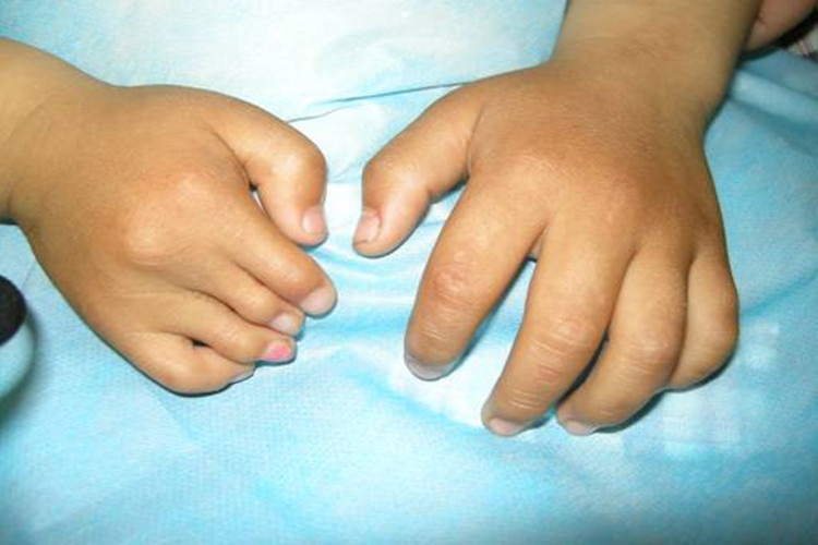 先天性手指鹅颈畸形图