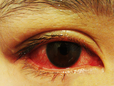 红眼病患者以眼睛发红,充血为典型症状,严重时结膜全部发红,并伴随
