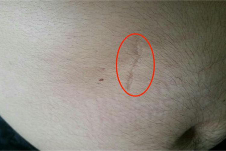 萎缩性瘢痕腹部症状图