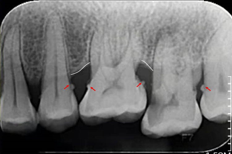 龈下牙石X线影像图