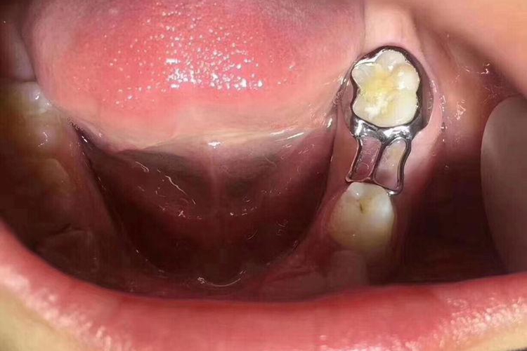 远中导板式间隙保持器图