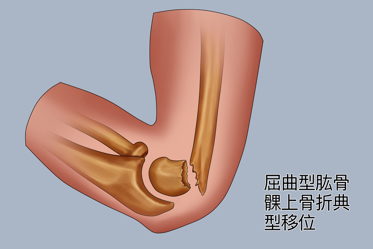屈曲型髁上骨折图 屈曲型髁上骨折图