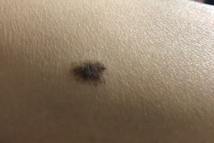 腿上色素痣图 腿上色素痣图