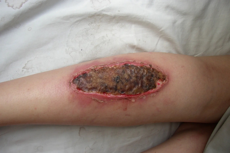 烫伤后感染图