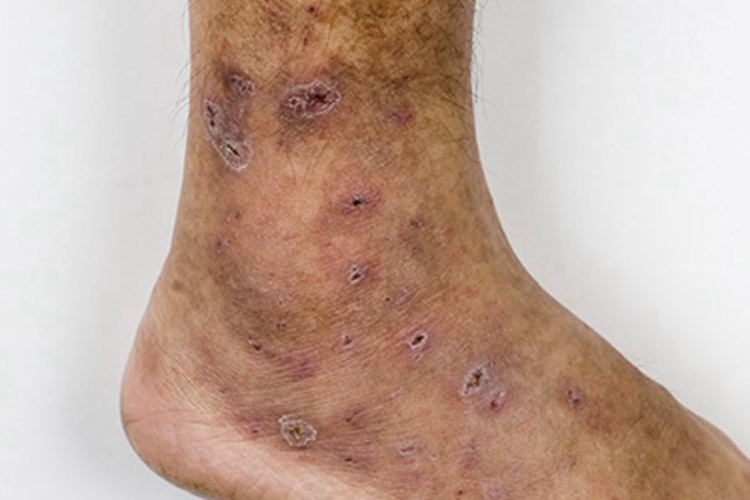 血管萎缩性皮肤异色病脚踝斑图 血管萎缩性皮肤异色病脚踝斑图