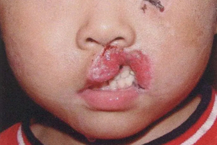 唇缺损嘴唇裂口图