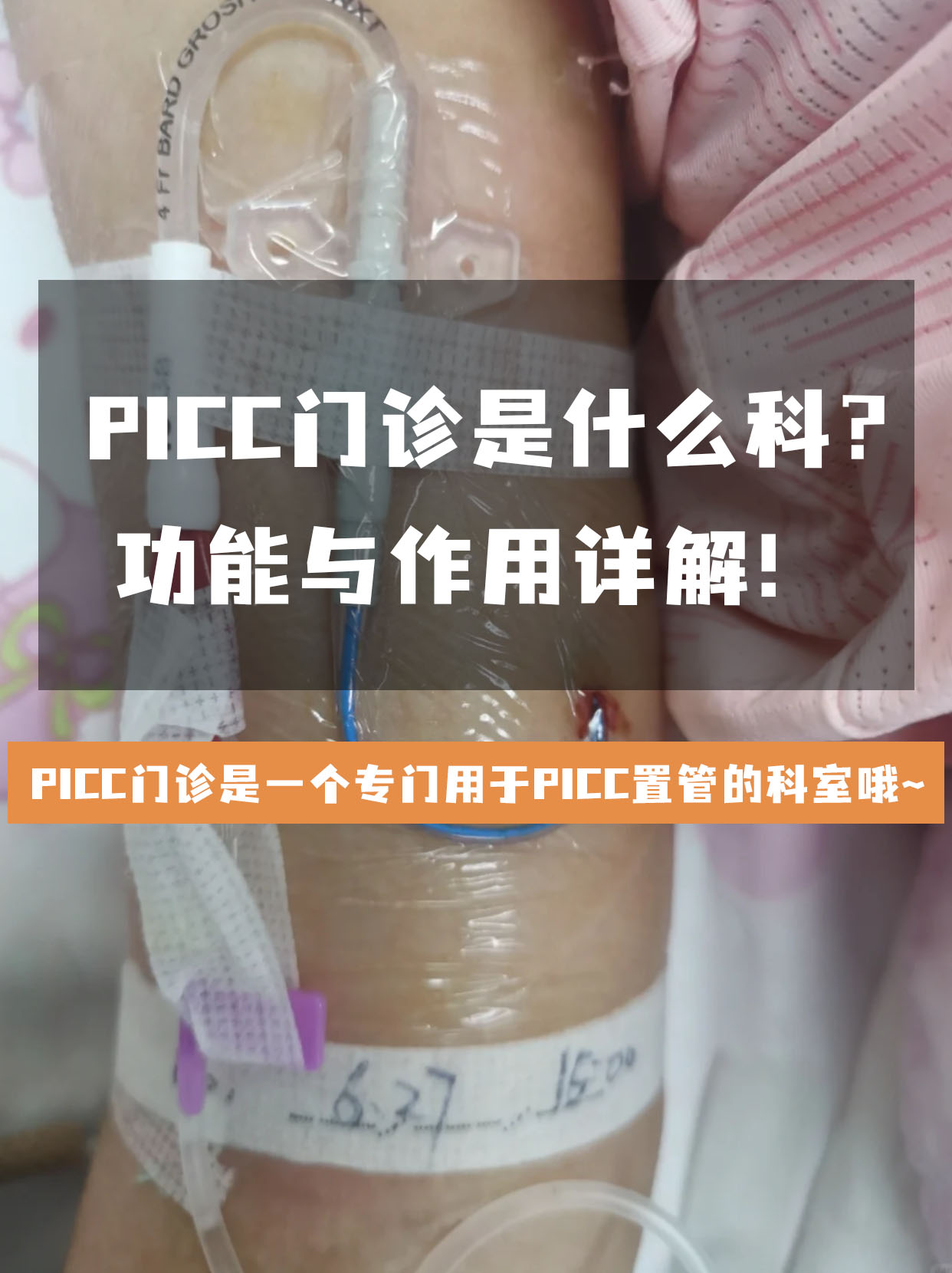 PICC门诊是什么科？功能与作用详解！
