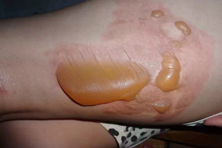 二度烫伤大腿症状图