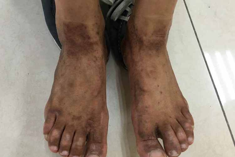 化疗后脚部色素沉着图