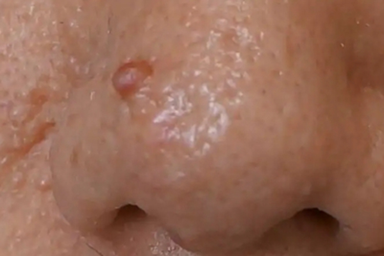 皮脂腺瘤鼻翼疙瘩图