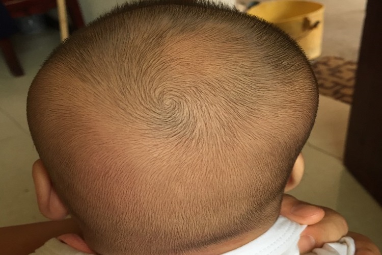 平斜头畸形图 平斜头畸形图