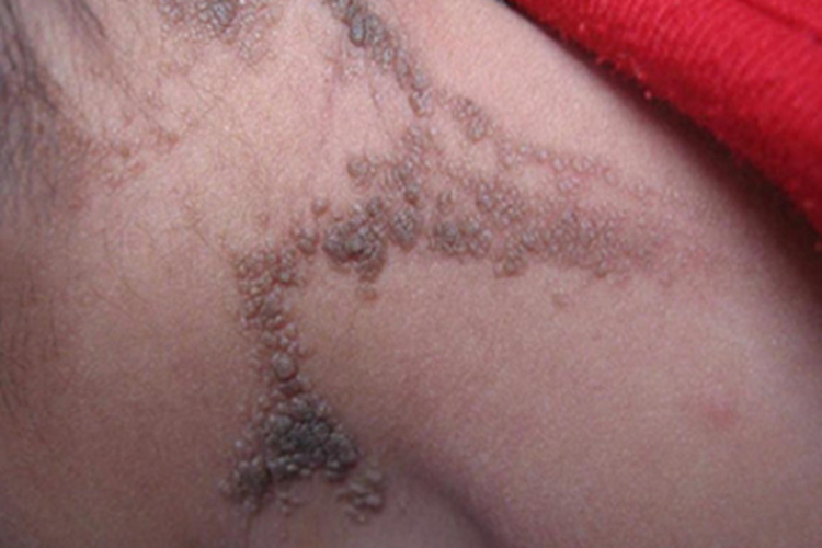 表皮痣后颈疙瘩图