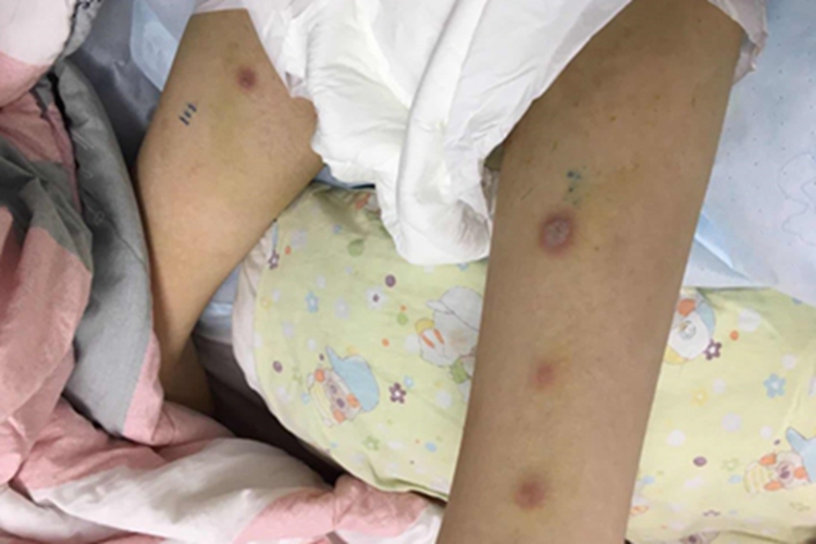 播散性镰刀菌病红斑图