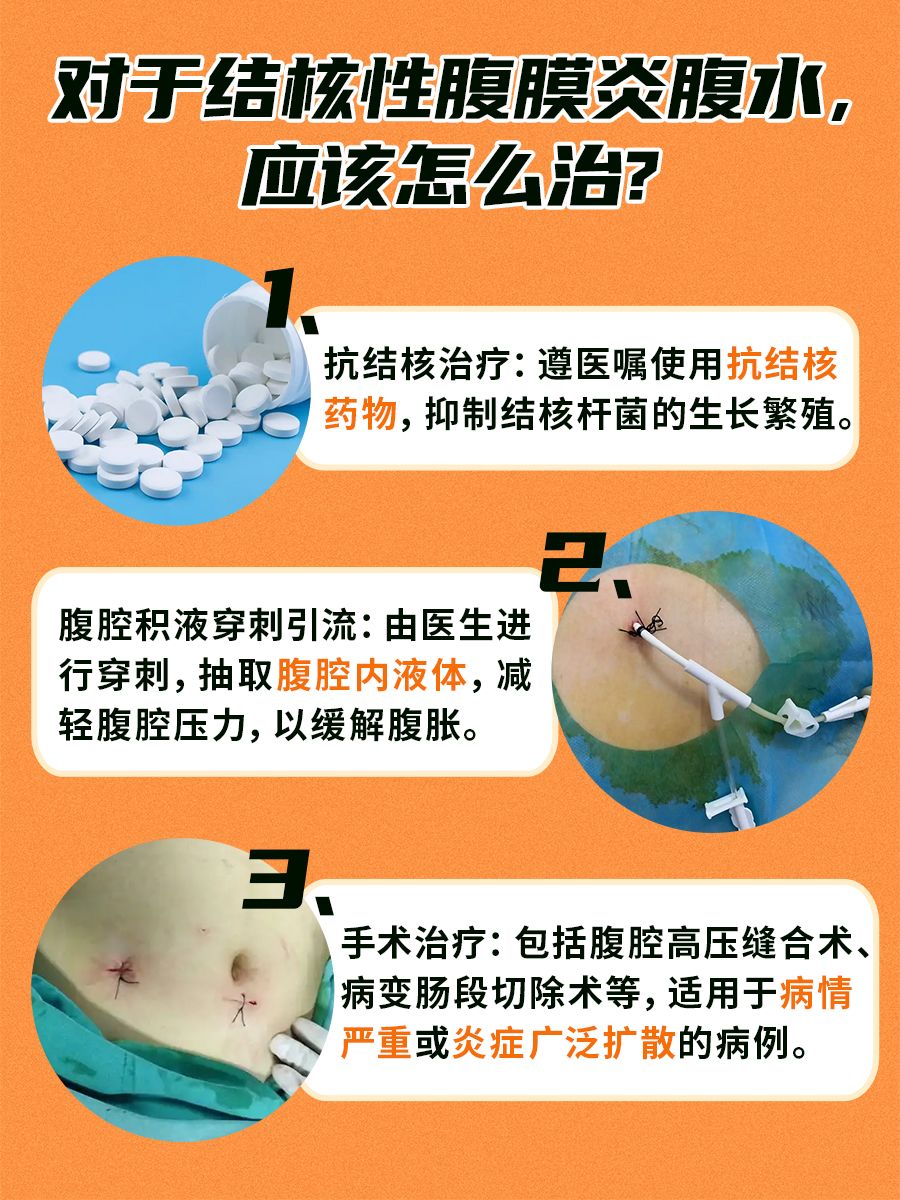 结核性腹膜炎腹水,多久治好?医生来回答