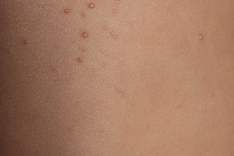 传染性软疣初期图