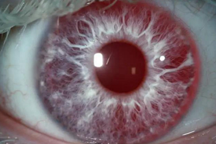 眼白化病瞳孔发红图