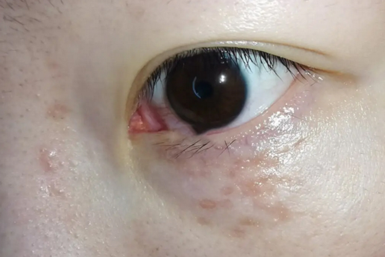 汗管瘤激光后一月图 汗管瘤激光后一月图