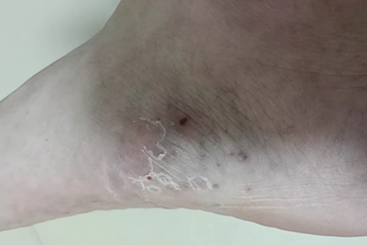 水疱型足癣脚部结痂图