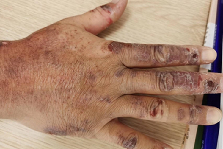 慢性接触性皮炎手指症状图