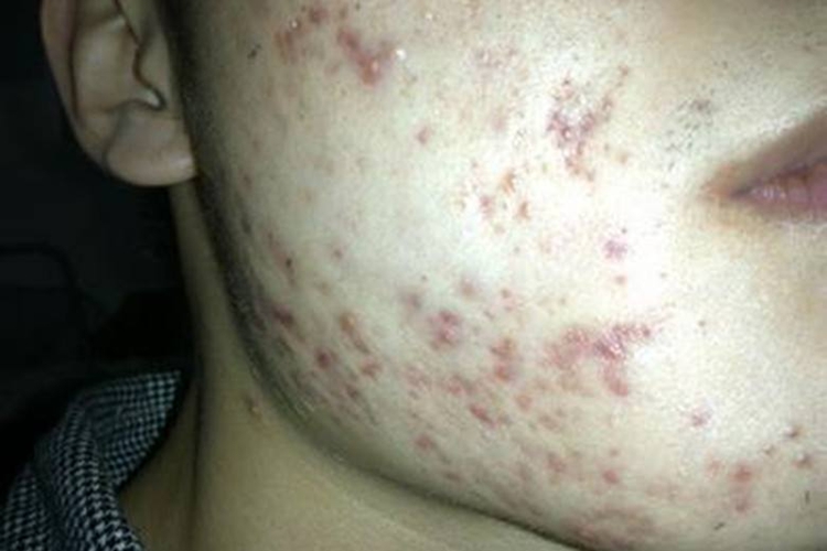 药物性痤疮图