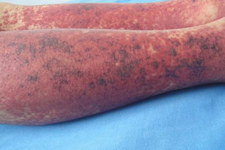 小孩重度过敏性紫癜图 小孩重度过敏性紫癜图