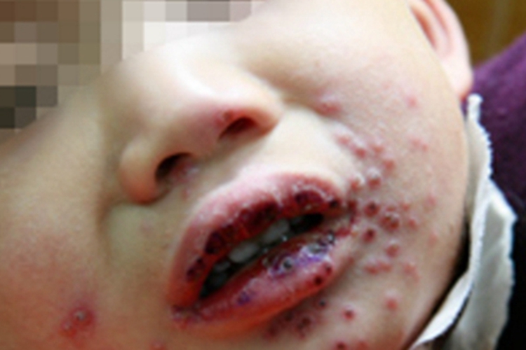 手足口病嘴唇症状图