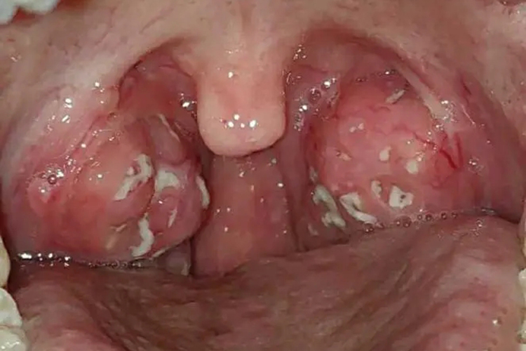 化脓性扁桃体炎图