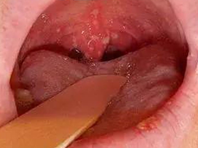 疱疹性咽峡炎咽喉红肿图.jpg