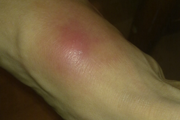 蜂窝织炎脚背有红斑图