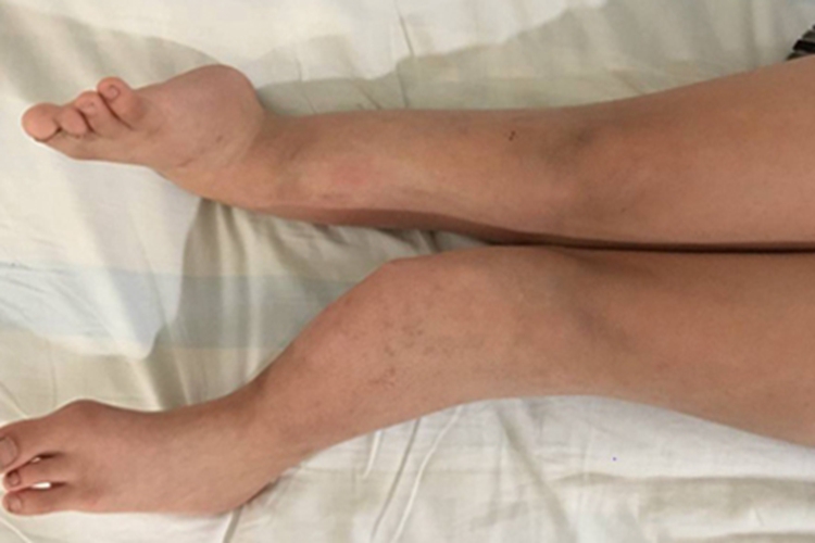 先天性腓骨缺如腿症状图 先天性腓骨缺如腿症状图