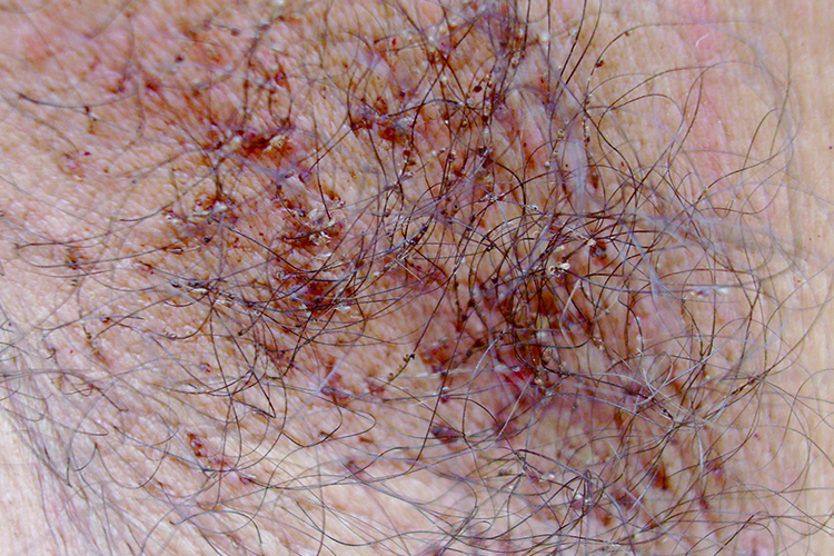 阴虱丘疹蓝斑图 阴虱丘疹蓝斑图