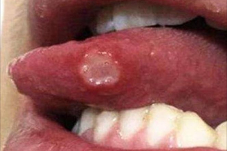 轻型口疮舌左侧溃疡图