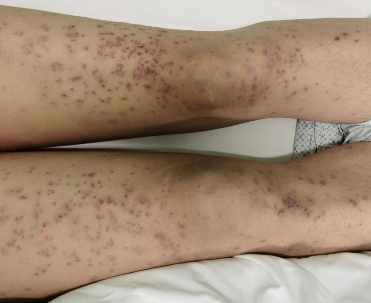 红斑狼疮腿上紫红色斑图 红斑狼疮腿上紫红色斑图