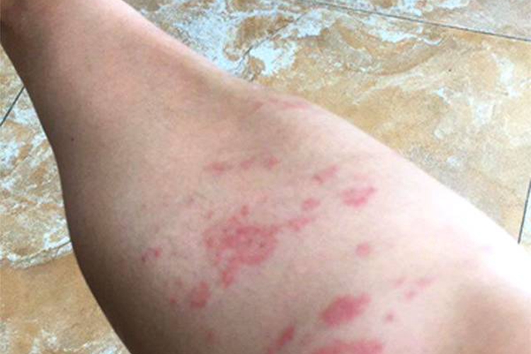 急性湿疹图