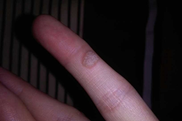 经典型上皮样肉瘤手指长结节图 经典型上皮样肉瘤手指长结节图