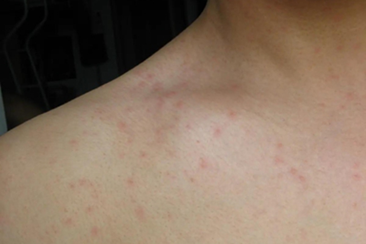 轻型麻疹皮疹图 轻型麻疹皮疹图