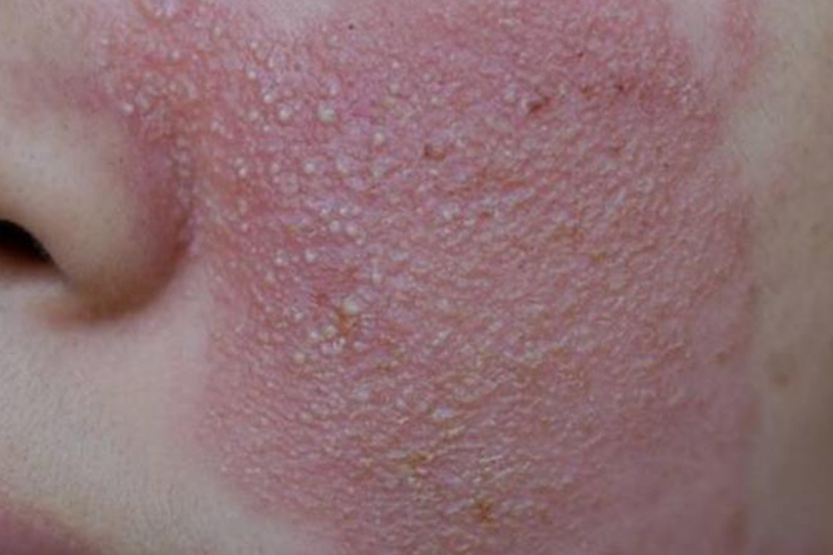 吃头孢克肟脸上起疹子图片