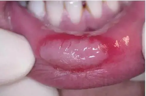 口腔黏膜灰白膜图<br />
