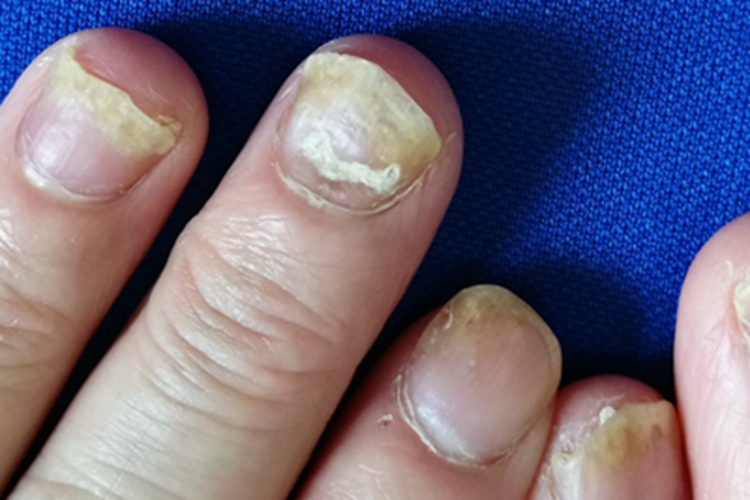 银屑病甲指甲粗糙发黄图