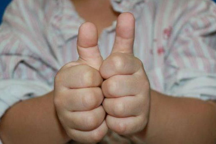 先天性扳机指畸形图