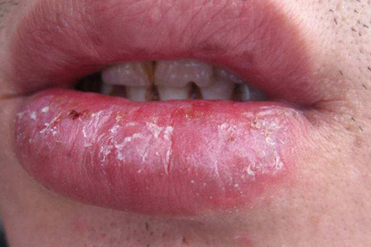 慢性光化性唇炎脱屑图