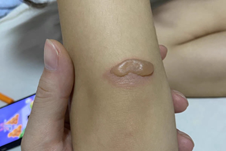 二度烫伤肘部症状图 二度烫伤肘部症状图