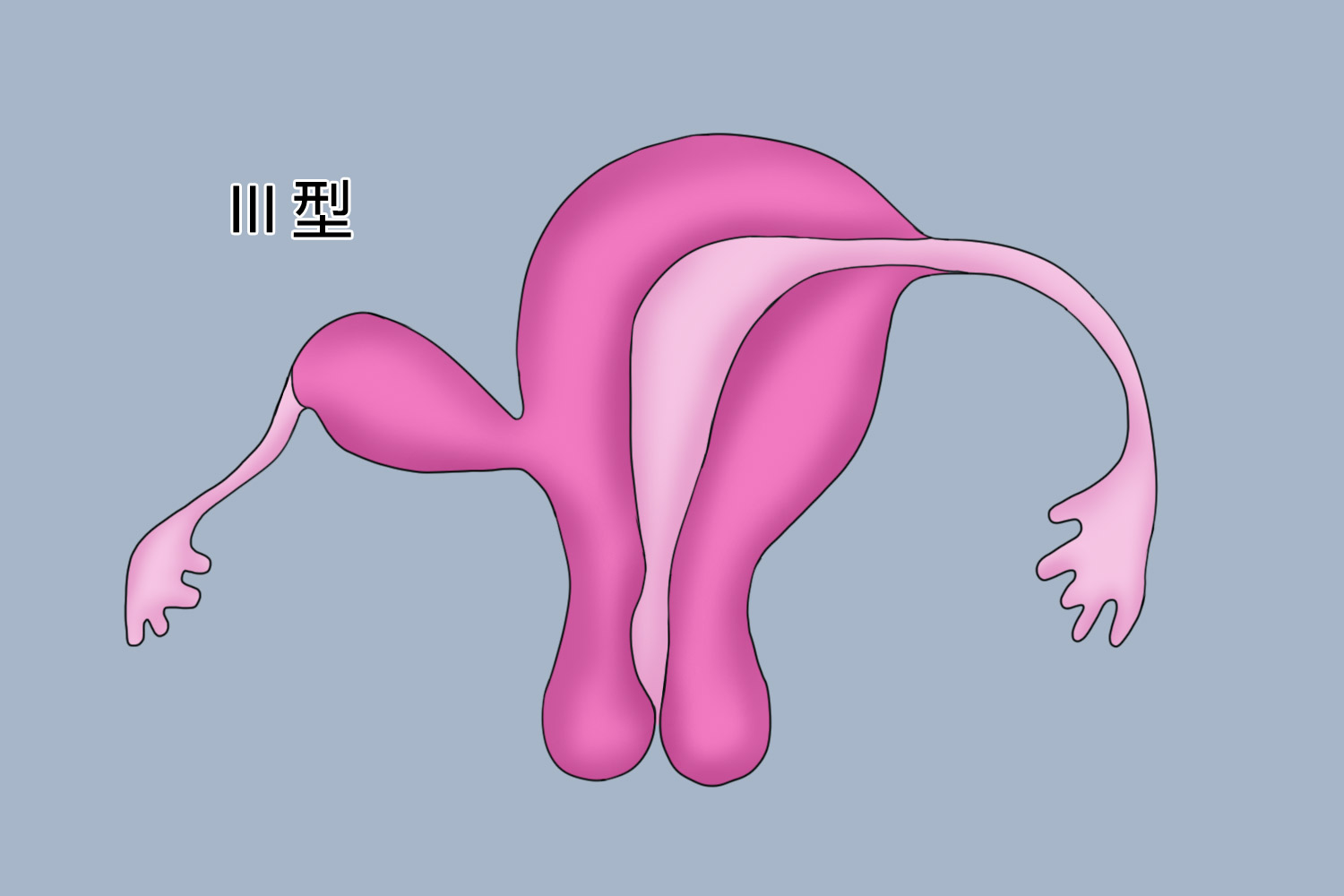 Ⅲ型残角子宫图